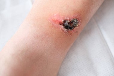 Yetişkin bir erkek hastanın bacağındaki ciddi yanık, kızarıklık, deri yaralanması, tıbbi bakım, insan dokusu yenilenmesi.