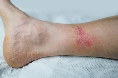 Yetişkin bir erkek hastanın bacağındaki ciddi yanık, kızarıklık, deri yaralanması, tıbbi bakım, insan dokusu yenilenmesi.