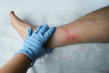 Doktor, yetişkin bir hastanın bacağındaki ciddi yanık, kızarıklık, deri yaralanması, tıbbi bakım, insan dokusu yenilenmesi gibi ciddi iyileşme yaralarını tedavi ediyor.