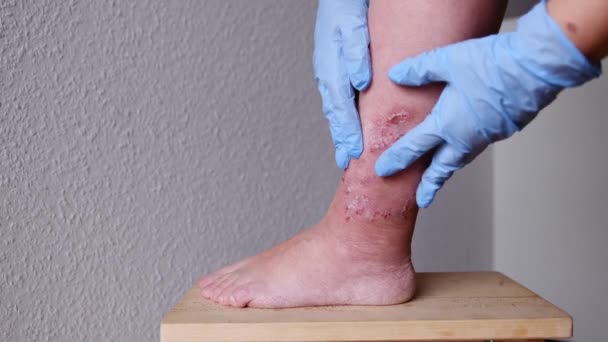 医生用成年女性病人的疤痕 皮肤疤痕 医疗护理的概念 人类组织再生等来治疗小腿上的巨大伤口 — 图库视频影像