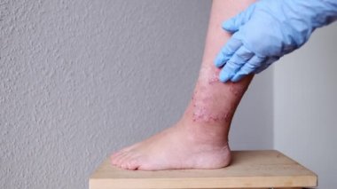 Doktor bacağının alt kısmındaki iyileşme yaralarını tedavi ediyor. Yetişkin kadın hastaların yaraları, kızarıklık, cilt yaralanması, tıbbi bakım, insan dokusu yenilenmesi.