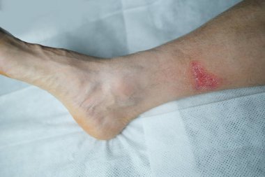 Yetişkin bir erkek hastanın bacağındaki ciddi yanık, kızarıklık, deri yaralanması, tıbbi bakım, insan dokusu yenilenmesi.