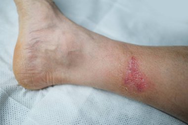 Yetişkin bir erkek hastanın bacağındaki ciddi yanık, kızarıklık, deri yaralanması, tıbbi bakım, insan dokusu yenilenmesi.