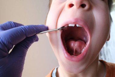 dentist, doctor examines oral cavity of small patient, length of frenum of the tongue, boy, kid performs articulation exercises for mouth, concept of speech disorders, correction clipart