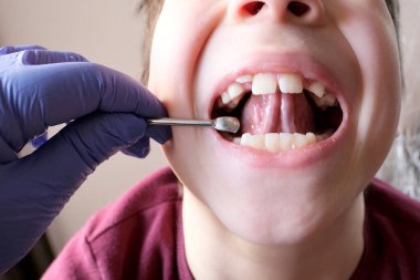 Dişçi, doktor küçük bir hastanın ağız boşluğunu, dilin cinnet süresini, çocuk, çocuk ağız için eklem egzersizleri, konuşma bozuklukları, düzeltme...