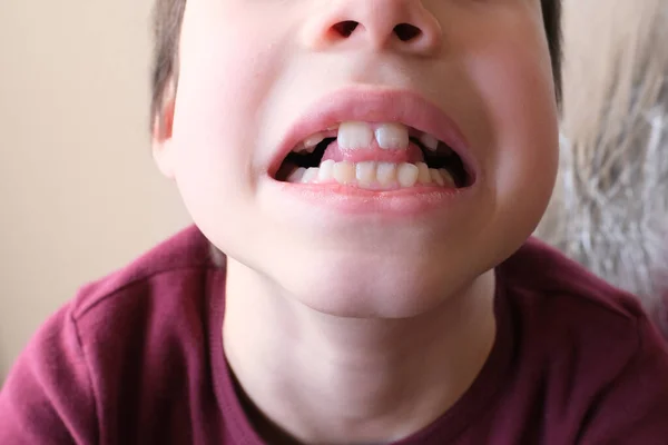 Pequeno Paciente Molares Crescem Menino Criança Com Boca Aberta Dentes — Fotografia de Stock