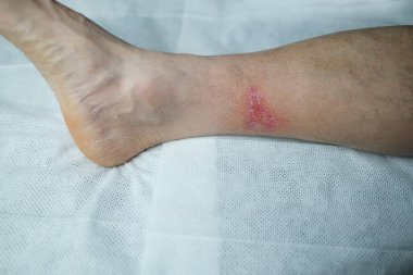 Yetişkin bir erkek hastanın bacağındaki ciddi yanık, kızarıklık, deri yaralanması, tıbbi bakım, insan dokusu yenilenmesi.