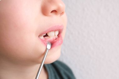 Küçük bir çocuk, 7-8 yaşlarında ağzı açık oturuyor, dişleri yakın, dişleri dişçi tarafından inceleniyor, diş tedavisi kavramı, ısırık kontrolü.