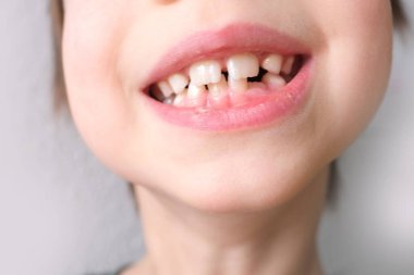 Küçük bir çocuk, 7-8 yaşlarında ağzı açık oturuyor, dişleri yakın, dişleri dişçi tarafından inceleniyor, diş tedavisi kavramı, ısırık kontrolü.