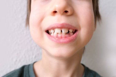 Küçük bir çocuk, 7-8 yaşlarında ağzı açık oturuyor, dişleri yakın, dişleri dişçi tarafından inceleniyor, diş tedavisi kavramı, ısırık kontrolü.