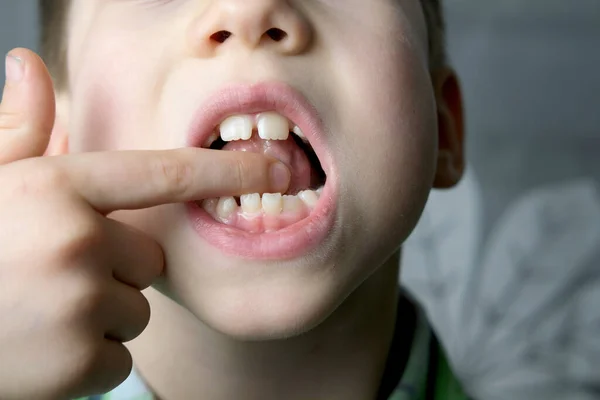Küçük hastanın ağız boşluğu, dilin cinneti, çocuk, çocuk ağız için eklem egzersizleri, konuşma bozukluğu konsepti, düzeltme
