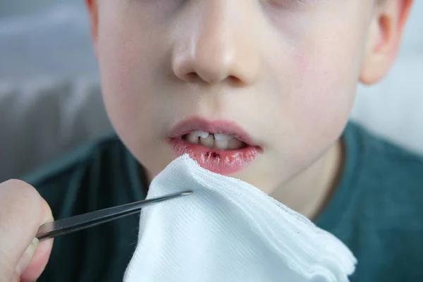 Dentist Doctor Examines Oral Cavity Small Patient Lip Burst Blood — Stockfoto