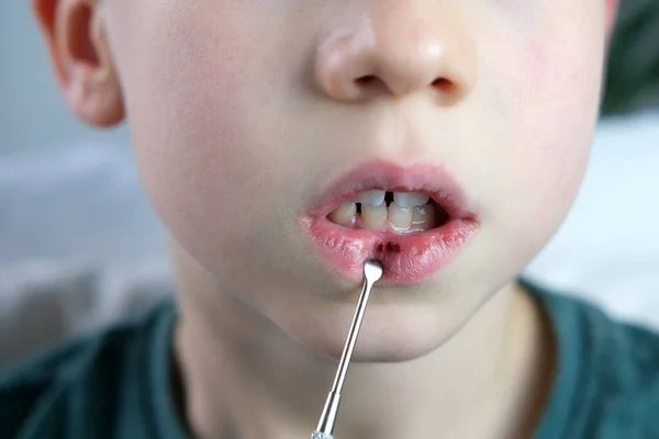 Dentist Doctor Examines Oral Cavity Small Patient Lip Burst Blood — Stock fotografie