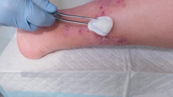 의사들은 환자의 다리에 수많은 상처를 합니다 긁히는 생기는 치료에 피부에 — 비디오