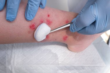 İnsan incik kemiğine yakın çekim, doktor yetişkin bir kadın hastanın bacağındaki sayısız yarayı tedavi ediyor, kızarıklık, yara, kaşınma, tıbbi bakım kavramı, cilde zarar verme.