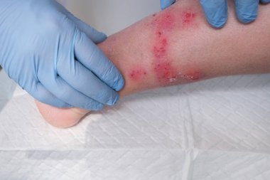 İnsan incik kemiğine yakın çekim, doktor yetişkin bir kadın hastanın bacağındaki sayısız yarayı tedavi ediyor, kızarıklık, yara, kaşınma, tıbbi bakım kavramı, cilde zarar verme.