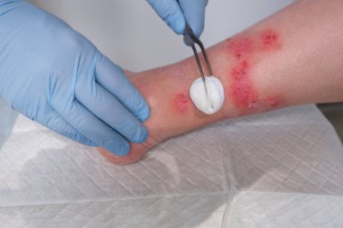 İnsan incik kemiğine yakın çekim, doktor yetişkin bir kadın hastanın bacağındaki sayısız yarayı tedavi ediyor, kızarıklık, yara, kaşınma, tıbbi bakım kavramı, cilde zarar verme.