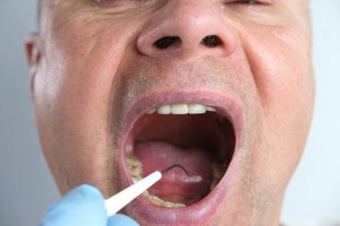 Yakın plan erkek doktor, yaşlı bir erkek hastanın ağız boşluğunu muayene ediyor, adamın ağzı sonuna kadar açık, diş tedavisi konsepti, diş bakımı...
