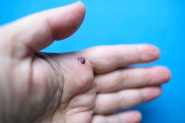 Γυναικείο Χέρι Υποδόρια Αιμορραγία Στην Παλάμη Τραύμα Από Τσίμπημα Στο — Φωτογραφία Αρχείου