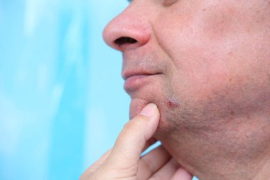 Çenesinde uçuk yarası olan bir adam, bağışıklığı zayıflamış viral deri döküntüleri, deri hastalıklarının tedavisi.