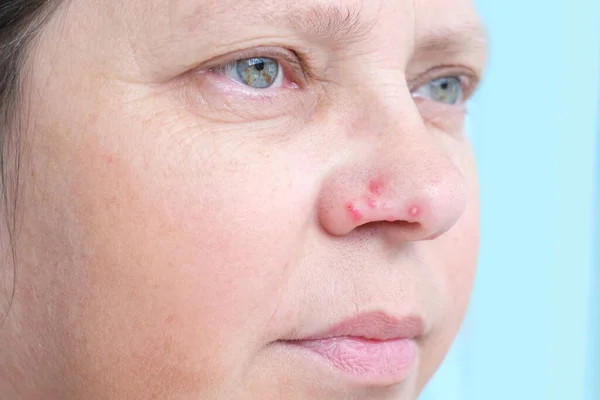 Wanita Dengan Lepuh Dari Herpes Pada Sayap Hidung Kulit Virus — Stok Foto