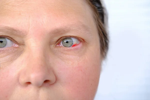 中年妇女近视部分面部50 55岁 人眼挫伤 血管爆裂 监视概念 视力检查 医疗程序 — 图库照片