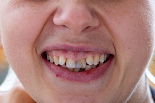 close-up portrait young smiling woman with joyful, authentic smile, proudly showing imperfect, crooked teeth, symbolizing happiness, Celebrating self-acceptance, natural beauty, and confidence