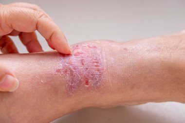 Dirseğine sarılı taze beyaz bandajlı yakın çekim kolu, yaralanma ve tedavi, kan veya plazma bağışından sonra donör, ilk yardım uygulaması, fiziksel travmadan sonra rehabilitasyon 