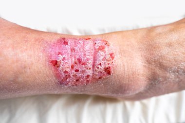 Dirseğine sarılı taze beyaz bandajlı yakın çekim kolu, yaralanma ve tedavi, kan veya plazma bağışından sonra donör, ilk yardım uygulaması, fiziksel travmadan sonra rehabilitasyon 