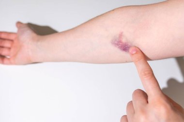 Dirseğine sarılı taze beyaz bandajlı yakın çekim kolu, yaralanma ve tedavi, kan veya plazma bağışından sonra donör, ilk yardım uygulaması, fiziksel travmadan sonra rehabilitasyon 