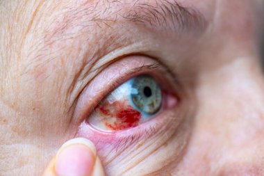 Şiddetli kızarıklık ve kırık kan damarları olan yakın çekim insan gözü, subkonjonktival kanama, tıbbi, sağlık ve göz hekimliği kavramları için klinik detay, hasta iyileştirme, kan damarı