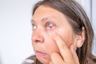 Şiddetli kızarıklık ve kırık kan damarları olan yakın çekim insan gözü, subkonjonktival kanama, tıbbi, sağlık ve göz hekimliği kavramları için klinik detay, hasta iyileştirme, kan damarı