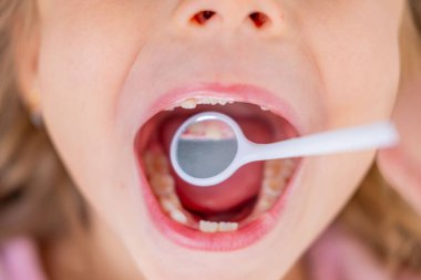 Genç hastanın ağzı steril ayna, ediatrik dişçilik ve oral sağlık, koruyucu bakım ve ilk ziyaret, bebek dişleri ve sakız sağlığı için düzenli kontroller, korku dişçiliği ile muayene ediliyor.