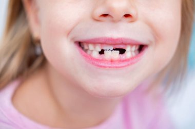 Gülümseyen çocuğun ağzı süt dişleri, bebek dişleri, büyüme ve gelişim arasındaki boşluğu gösteriyor, diş perisini ziyaret edin, neşeli ifade, çocukluk gelişimi, ön diş kaybı, masumiyet ve geçiş