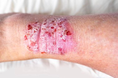 Bacağında yetişkin kadın hastaların yaralarıyla yakın yara, tahriş olmuş bacaklar, iltihaplı cilt ve ayak bileklerinde kırmızı egzama bantları, dermatoloji problemi, deri hastalığı konsepti, kronik dermatit,
