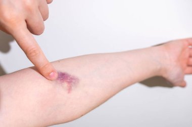 Doktor, kadın bacağındaki yaranın iyileşmesi için merhem sürüyor, kadın ayak bileğinin tedavisi, cilt yaralanması, sağlık desteği ve iyileşme rehabilitasyonu, hasta bakımı, yaralanma tedavisi