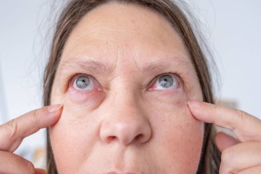 Görünür kızarıklık, ciddi şişkinlik, klinik gözlem periorbital ödem, iltihaplanma süreci, alerjik ya da bulaşıcı göz durumu, göz iltihabı ve travma, kanama.