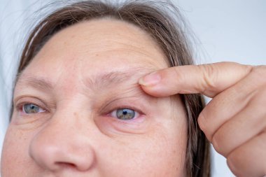 Görünür kızarıklık, ciddi şişkinlik, klinik gözlem periorbital ödem, iltihaplanma süreci, alerjik ya da bulaşıcı göz durumu, göz iltihabı ve travma, kanama.