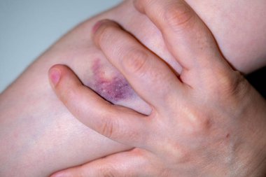 Tıbbi işlemden sonra kadın elinin üzerinde yakın plan çürük, dirsek bölgesinde kan alma, kan bağışı, tıbbi tedavi, semptom, vücut ağrısı, sağlık bakımı...