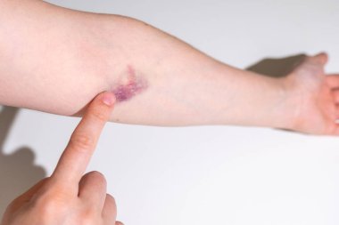 Tıbbi işlemden sonra kadın elinin üzerinde yakın plan çürük, dirsek bölgesinde kan alma, kan bağışı, tıbbi tedavi, semptom, vücut ağrısı, sağlık bakımı...