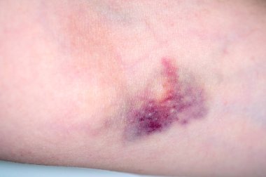 Tıbbi işlemden sonra kadın elinin üzerinde yakın plan çürük, dirsek bölgesinde kan alma, kan bağışı, tıbbi tedavi, semptom, vücut ağrısı, sağlık bakımı...