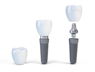 Beyaz izole insan implant diş. 3D render