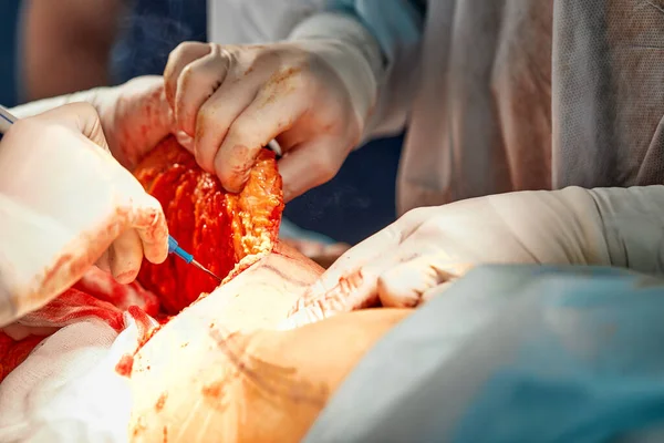 Operazione chirurgica addominoplastica. Rimuovere chirurgicamente il tessuto adiposo dall'addome — Foto Stock