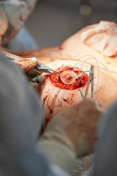 Equipo de cirujanos trabajando con Monitoreo del paciente en quirófano quirúrgico. aumento de senos de primer plano — Foto de Stock