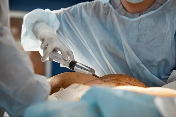 Косметическая операция по липосакции в операционной, показывающая группу хирургов во время операции — стоковое фото