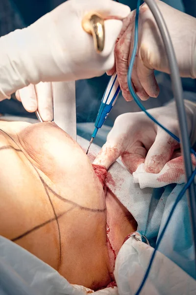 Mamoplastia, reconstrucción de las glándulas mamarias femeninas, después del cáncer, instalación de un expansor, primer plano, cirugía plástica de una mama femenina — Foto de Stock