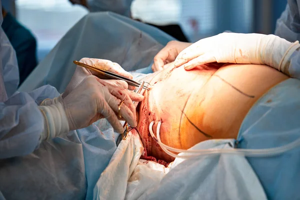 The doctor performs an operation to reconstruct the female breast. Close-up of plastic surgeon performing implantation procedure, breast cancer — Stock Photo, Image