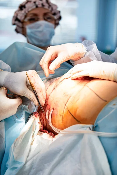 Il medico esegue un'operazione per ricostruire il seno femminile. Primo piano del chirurgo plastico che esegue la procedura di impianto, cancro al seno — Foto Stock
