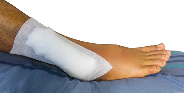 Bliska złamaną nogę — Zdjęcie stockowe