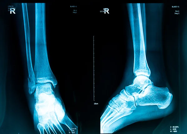 Права нога людини анкель і рентгенівський знімок ноги — стокове фото